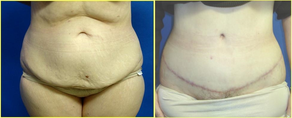 Abdominoplasty or Tummy Tuck Before Surgery Seattle, Tacoma, WA