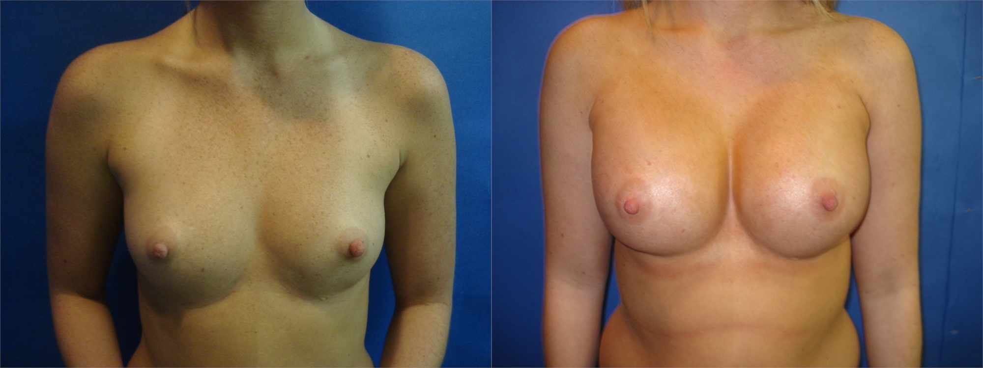 Breast Augmentation Before Surgery Seattle and Tacoma, WA