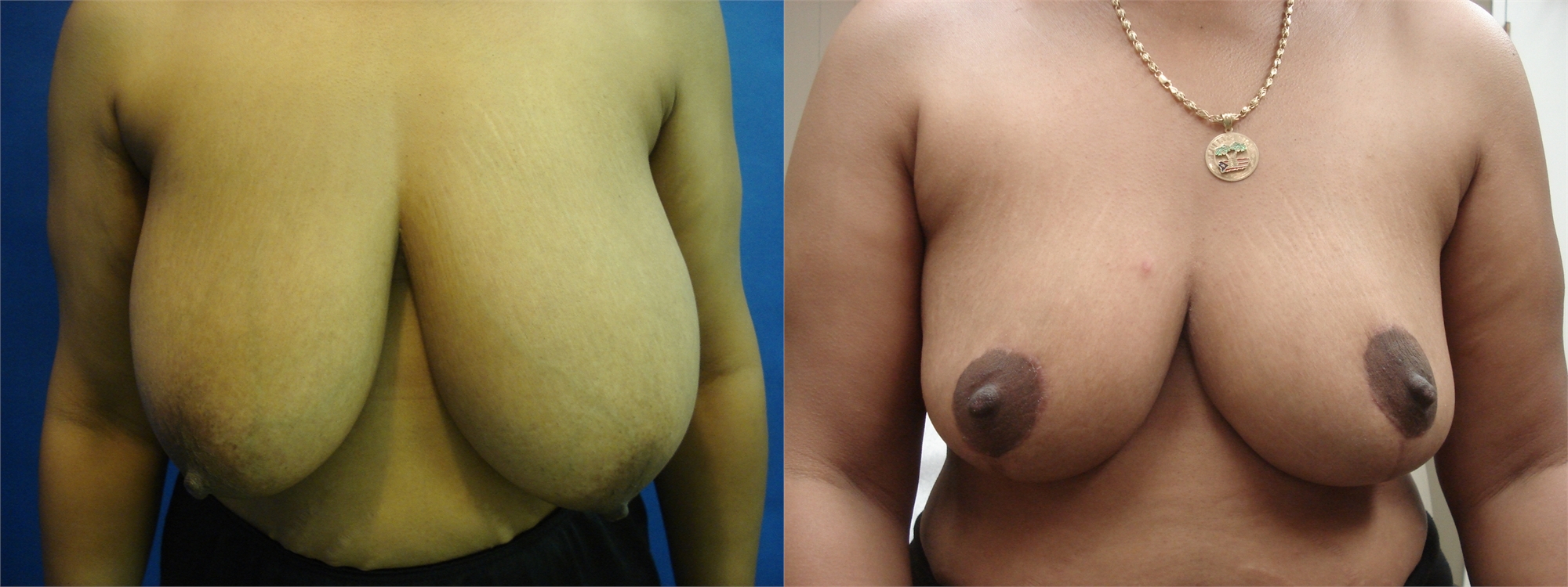 Breast Lift Before and After Surgery Tacoma, WA