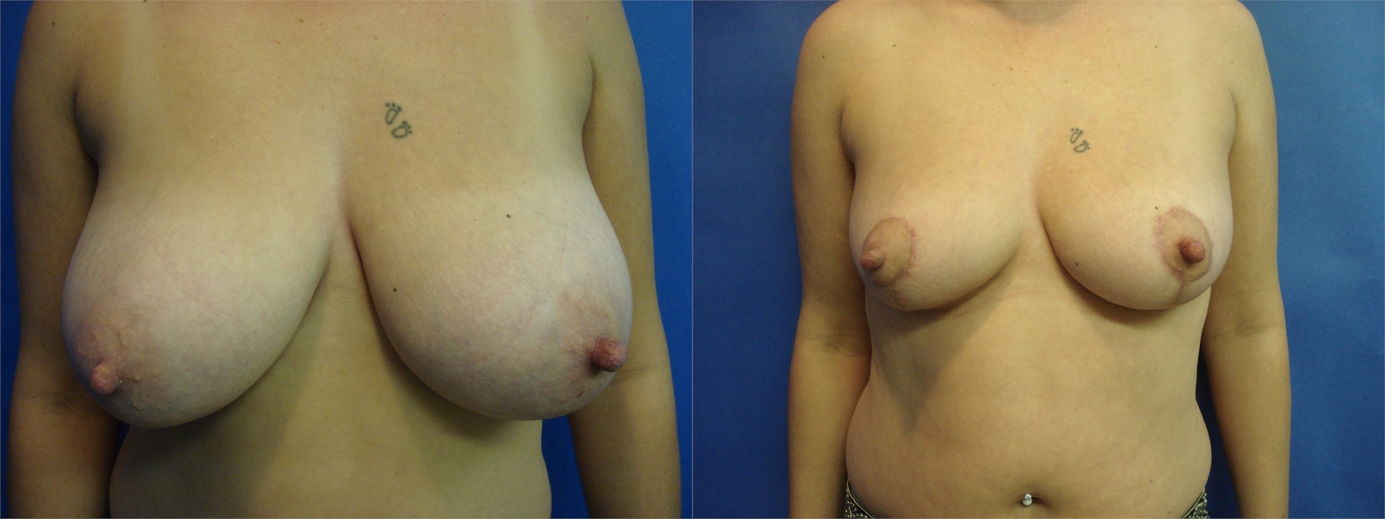 Breast Lift Before and After Photos Tacoma, WA