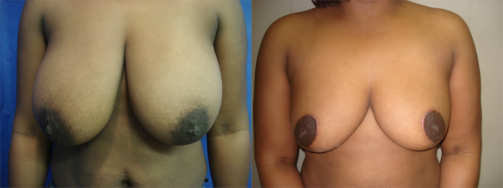 Breast Lift Before and After Seattle and Tacoma, WA