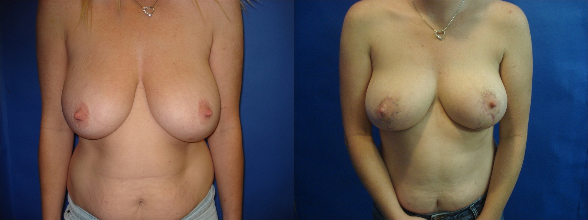 Breast Lift Before and After Photo Tacoma, WA