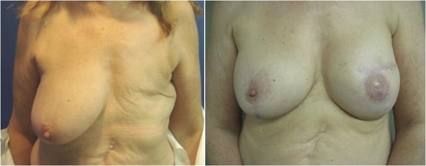 Breast Reconstruction Before Surgery Tacoma, WA