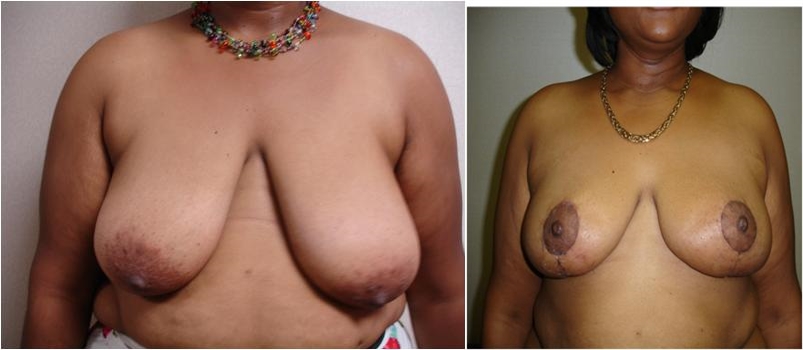 Breast Reduction Before Surgery Tacoma, WA