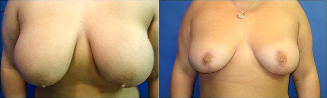 Before Breast Reduction Surgery Tacoma, WA