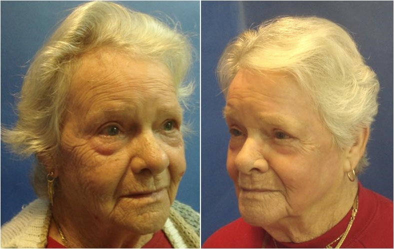 Before and After Fractional Resurfacing Procedure, Tacoma, WA
