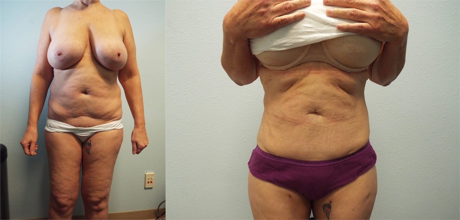 Liposuction Before and After Tacoma, WA