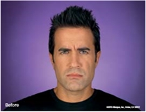 Image related to Botox for Tacoma Washington
