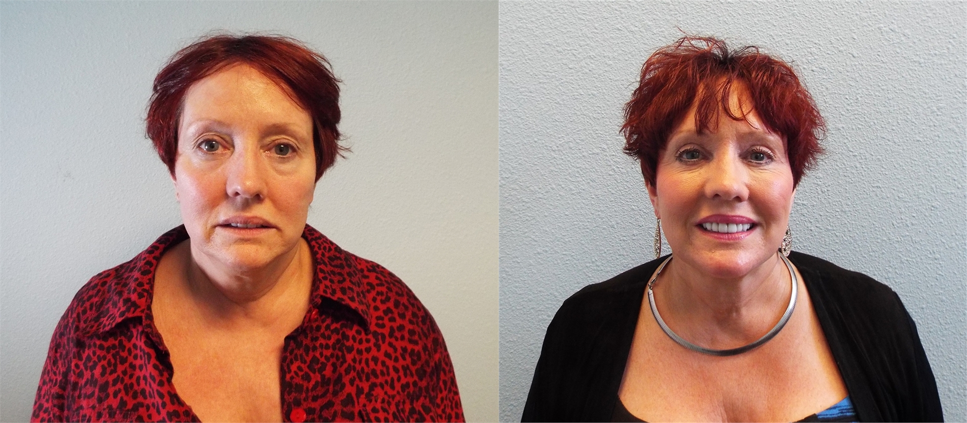 Blepharoplasty Before Surgery Tacoma, WA