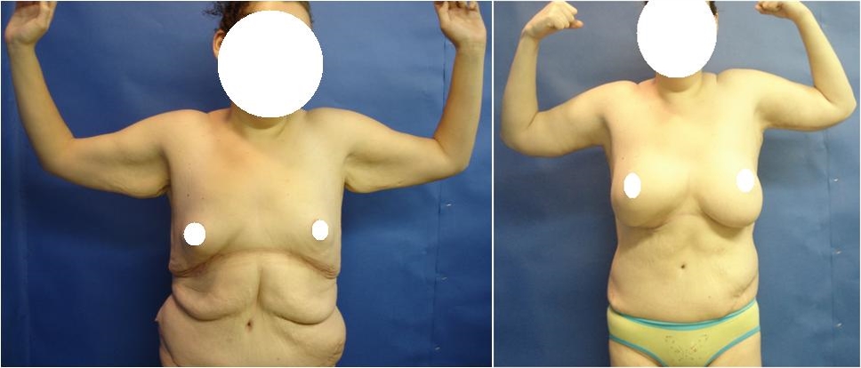 Before Body Contouring Surgery Tacoma, WA