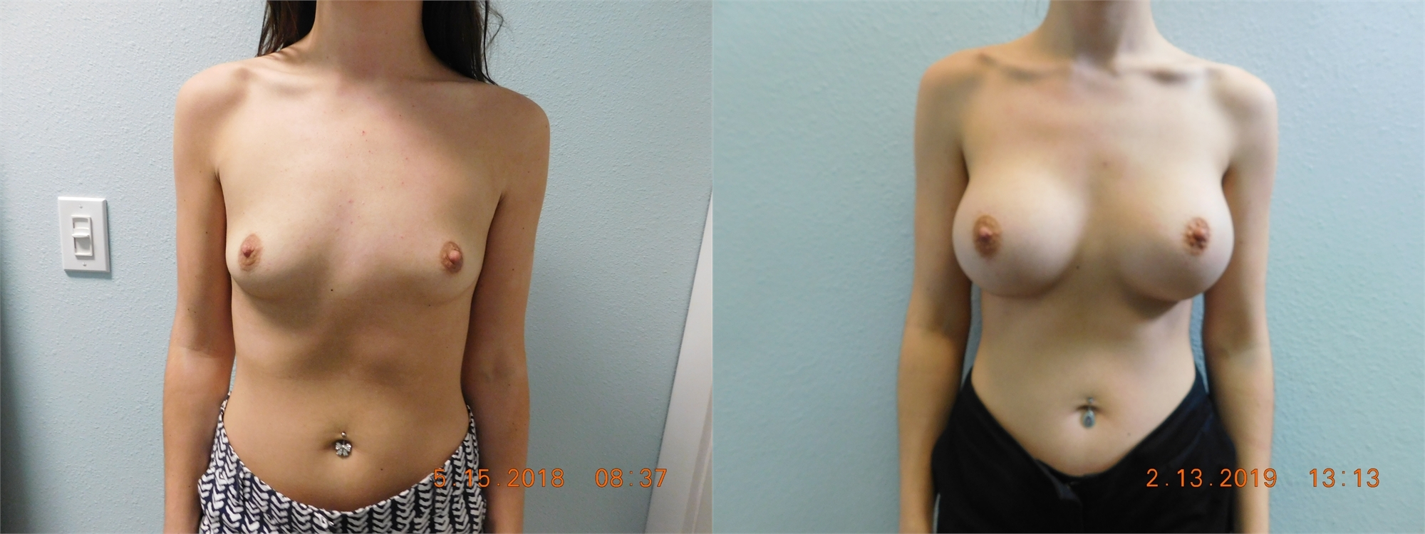 Breast Augmentation Before