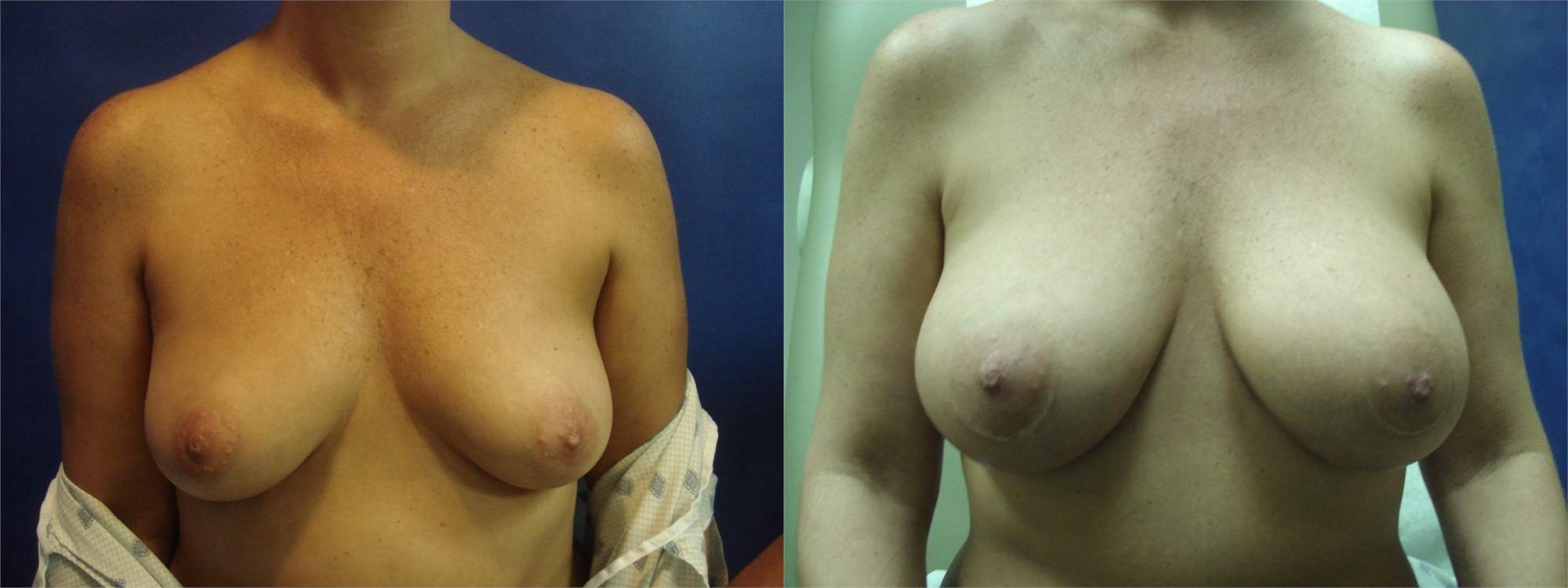 Before Breast Augmentation Surgery Seattle and Tacoma, WA