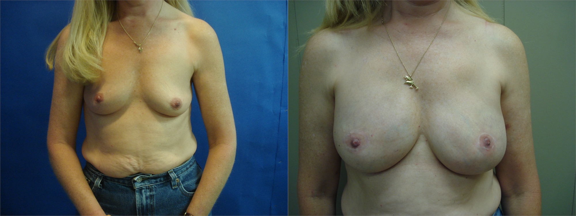 Breast Augmentation Before Surgery Seattle and Tacoma, WA
