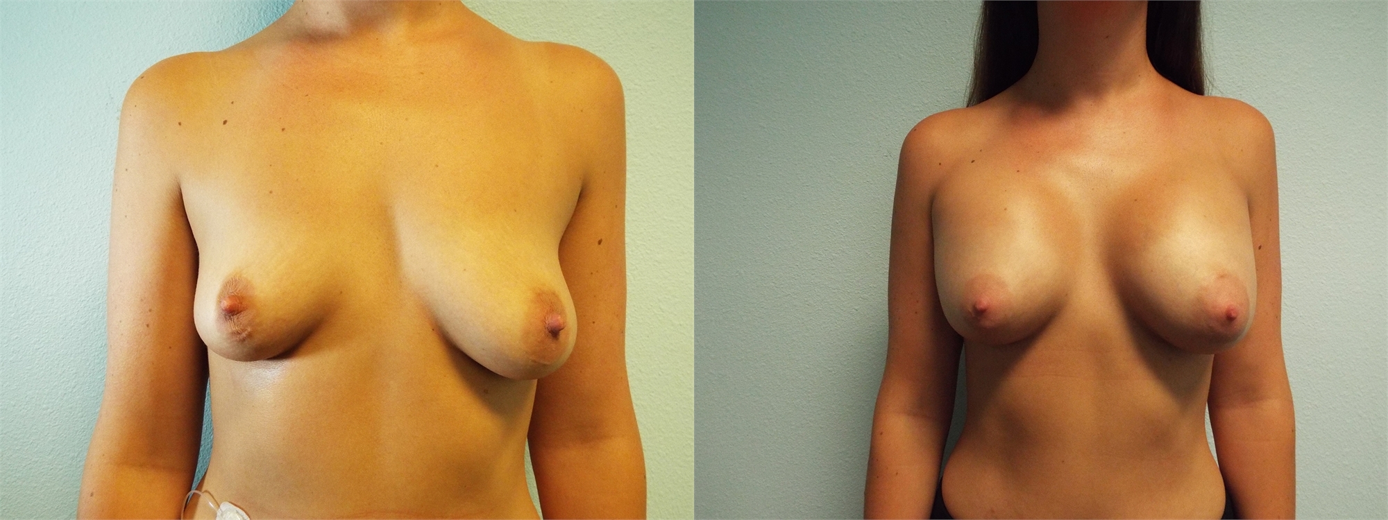 Before Breast Augmentation Surgery Seattle and Tacoma, WA