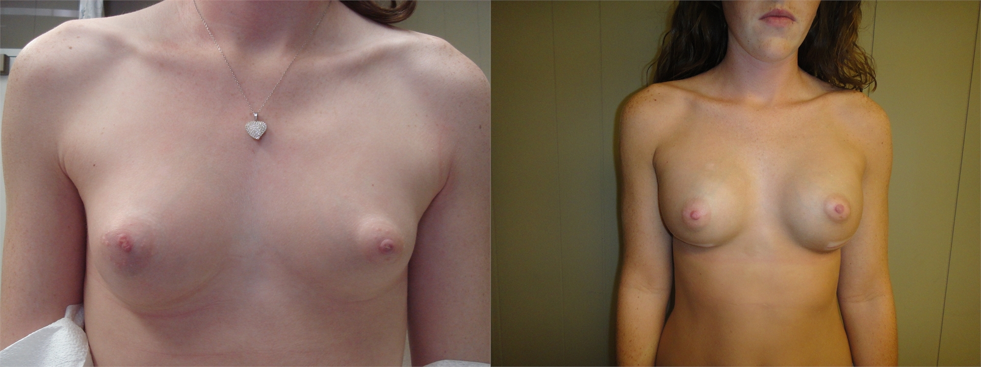 Before Breast Augmentation Surgery Seattle and Tacoma, WA