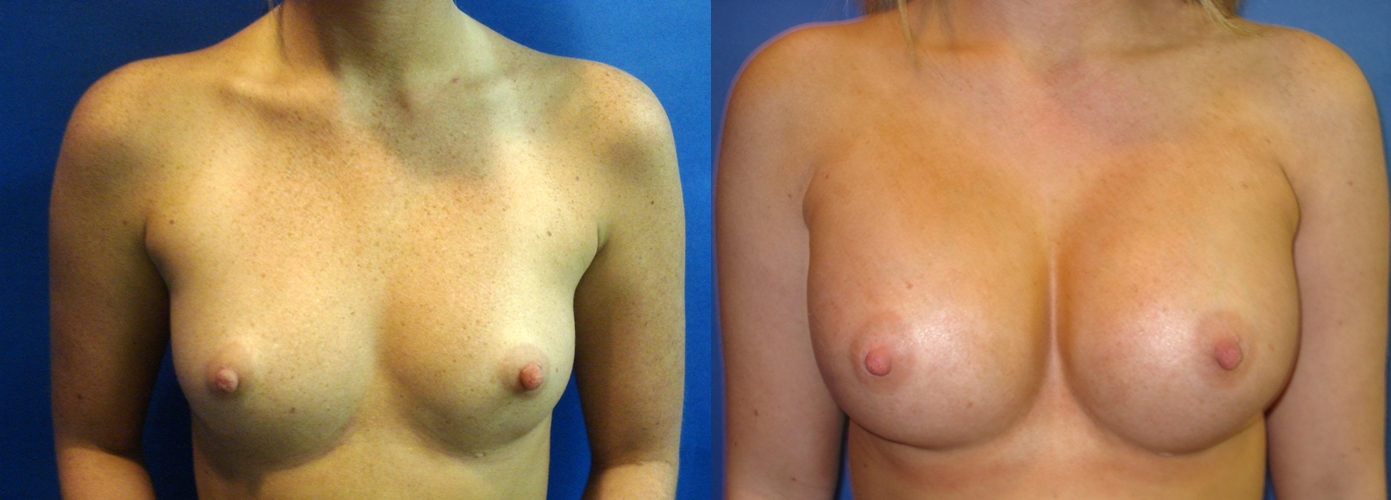 Before Breast Augmentation Surgery Seattle and Tacoma, WA