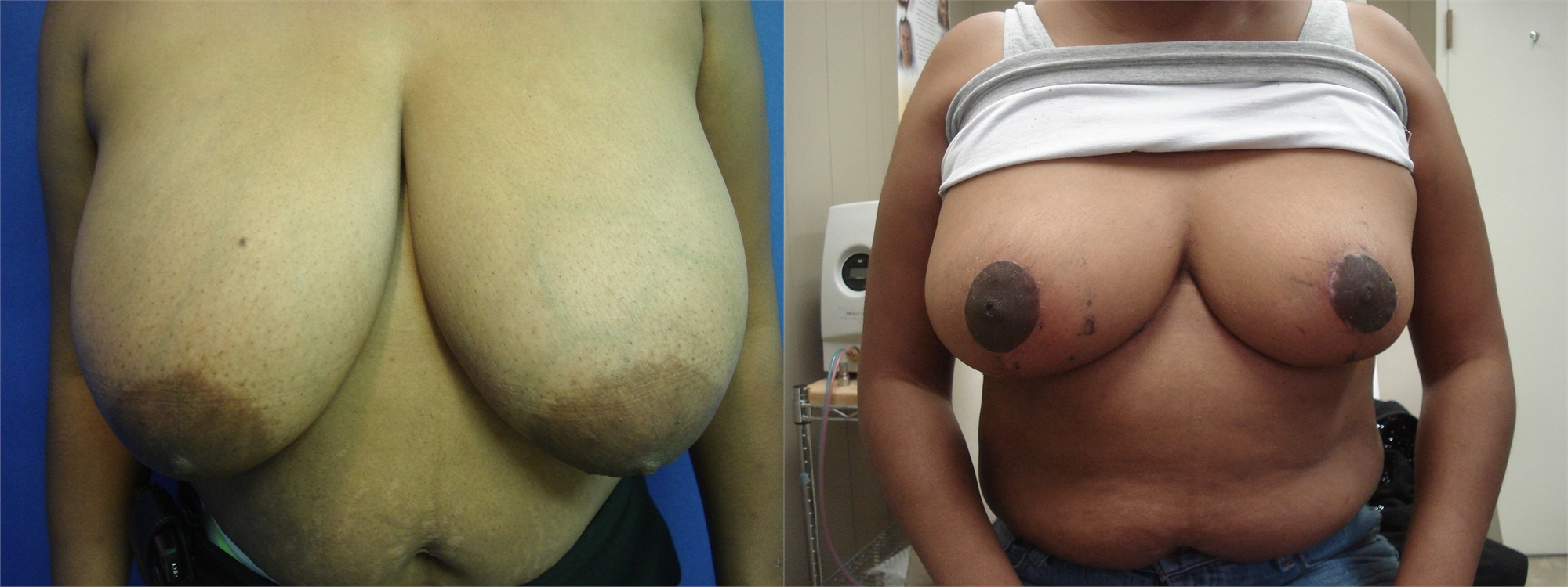 Before Breast Lift Surgery Seattle and Tacoma, WA