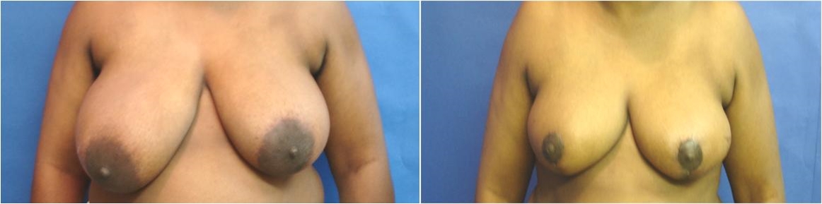 Breast Reduction Before and After Seattle and Tacoma, WA