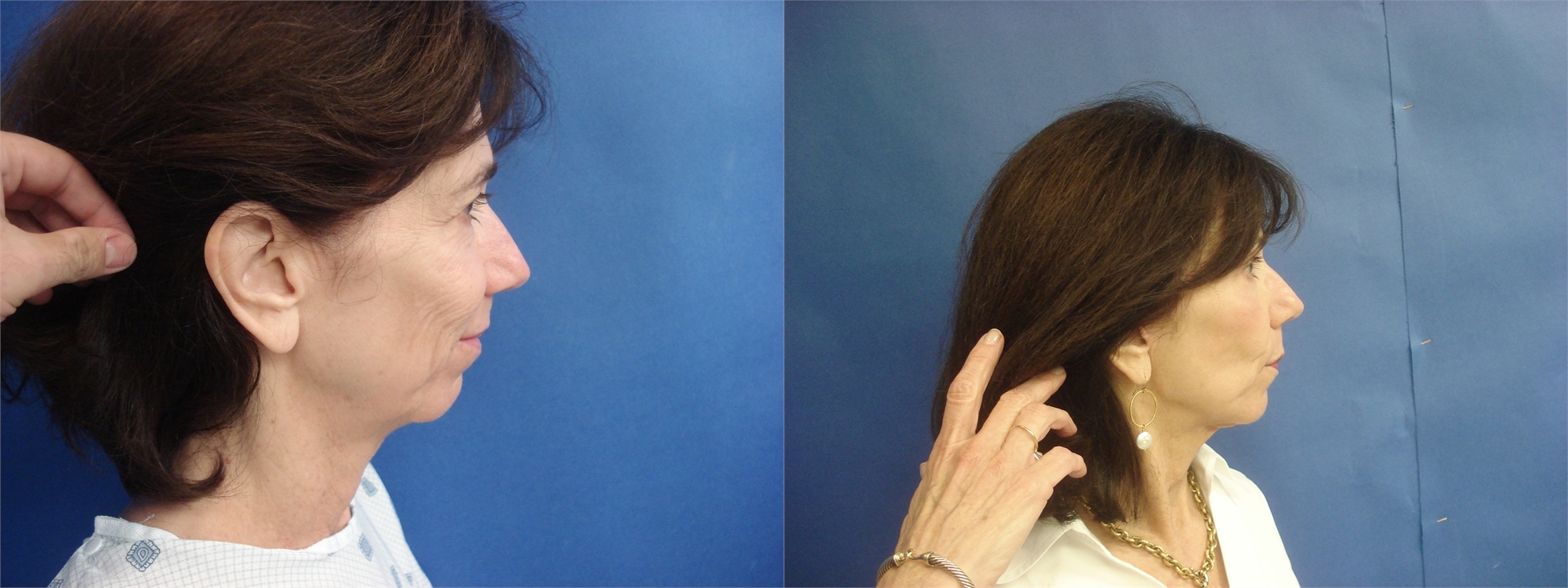 Facelift Before and After Surgery Seattle and Tacoma, WA