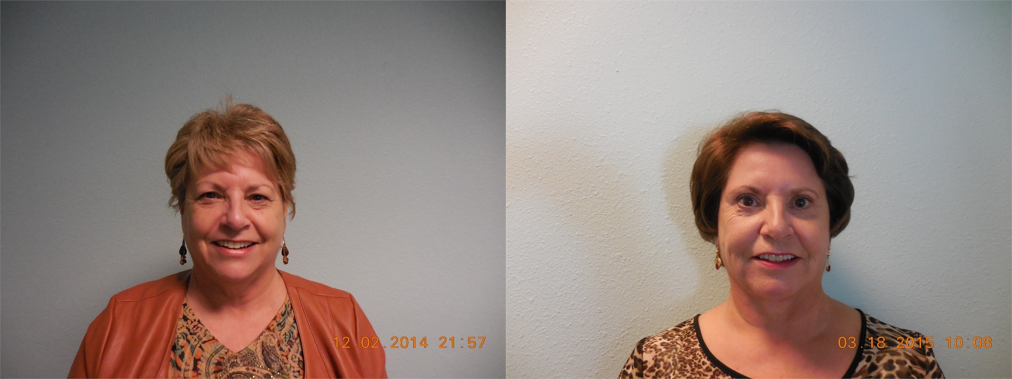 Fractional Laser Resurfacing Before