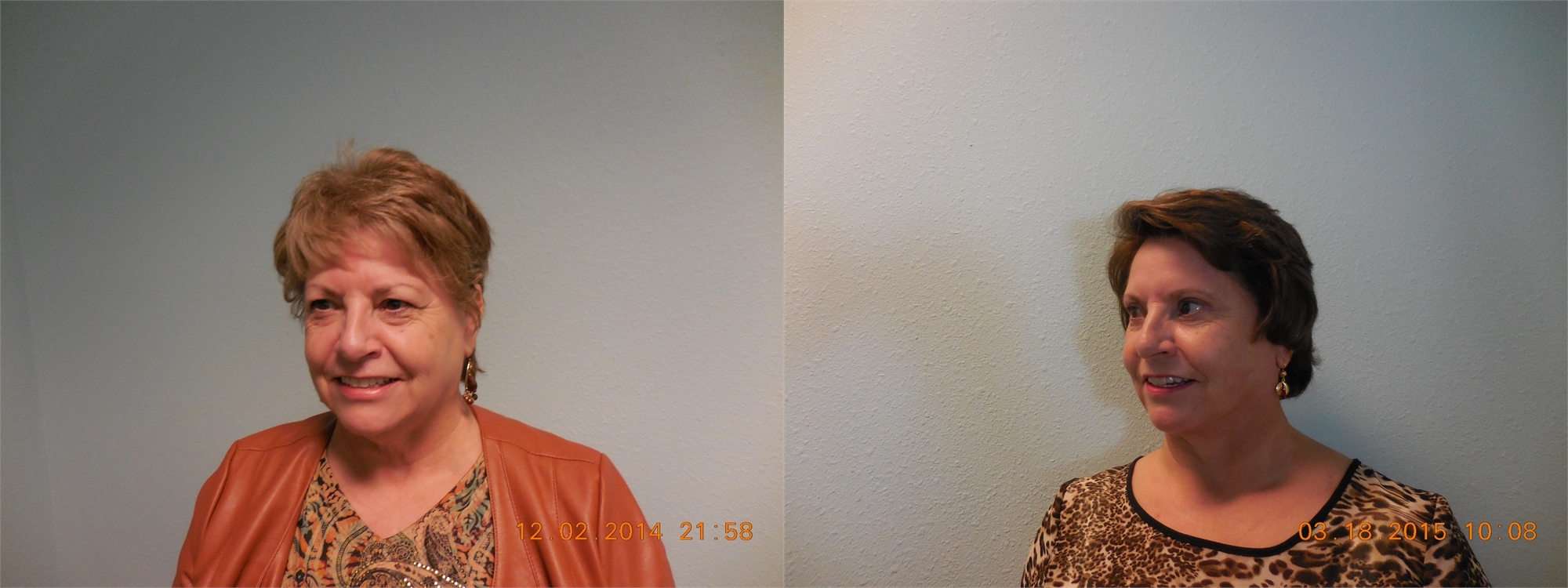 Fractional Laser Resurfacing Before