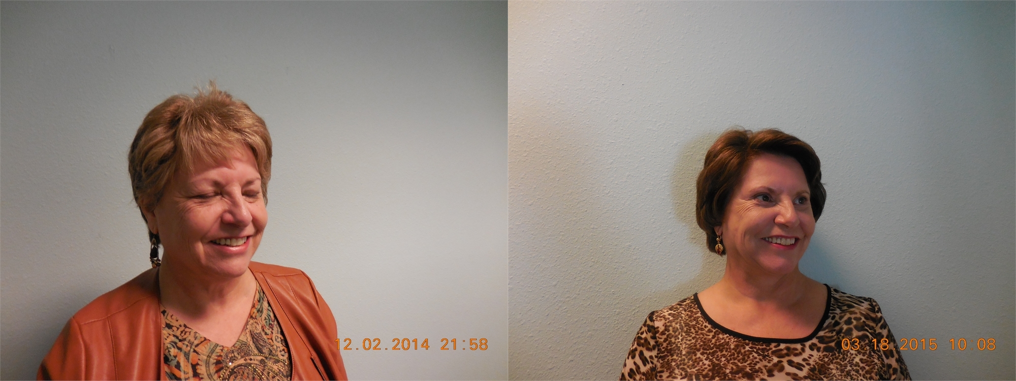 Fractional Laser Resurfacing Before