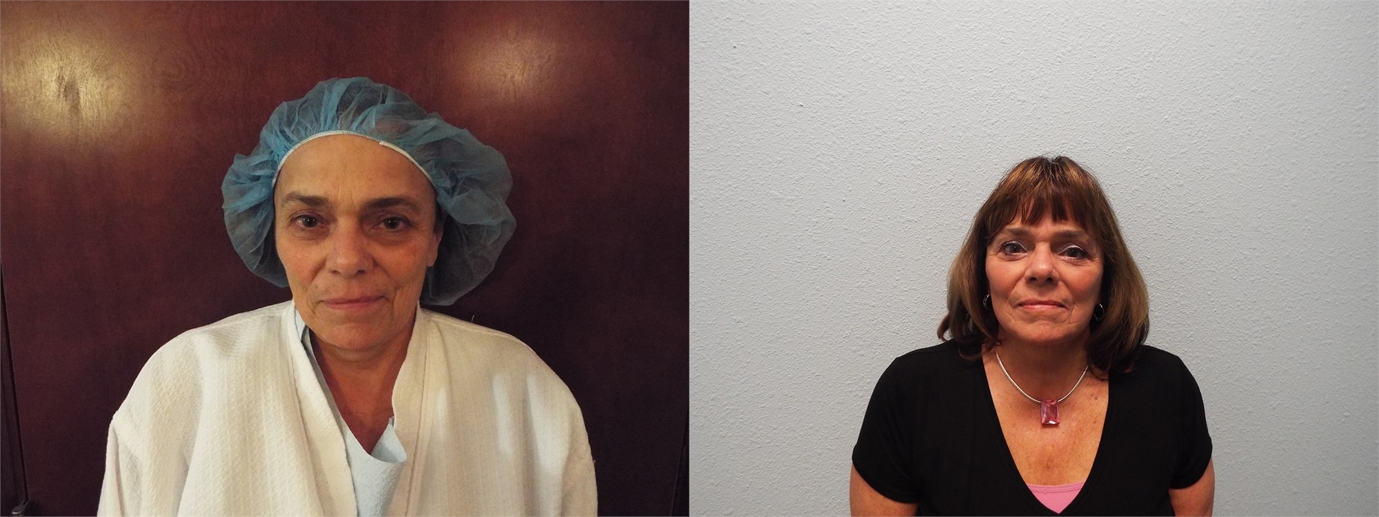 Before Facelift Surgery Seattle and Tacoma, WA