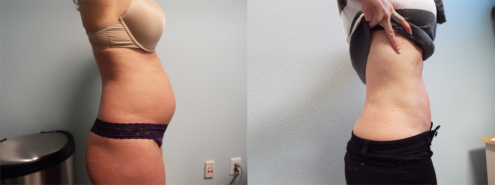 Before Laser Liposuction Surgery Seattle and Tacoma, WA