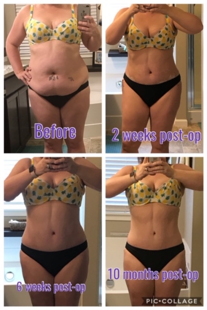 Liposuction and Tummy Tuck, Tacoma, WA