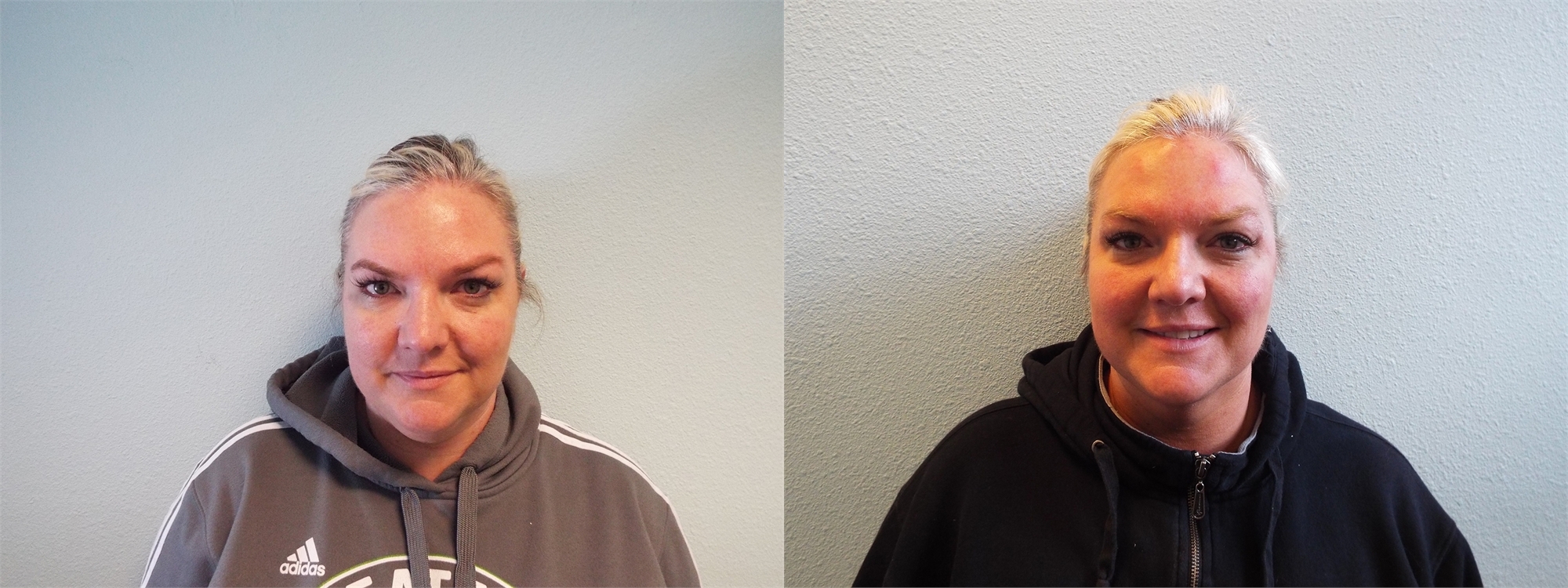 Chin Liposuction Before Surgery Tacoma, WA