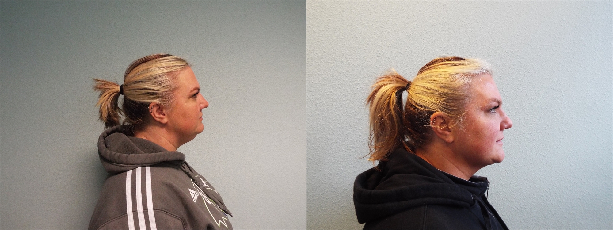 Before and After Chin Liposuction Surgery Tacoma, WA