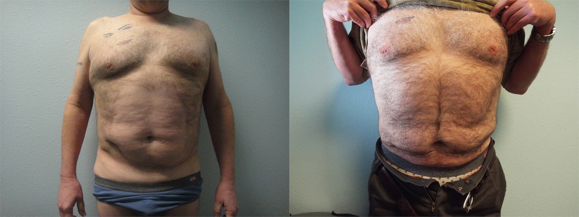 Before Chin Liposuction Surgery Tacoma, WA