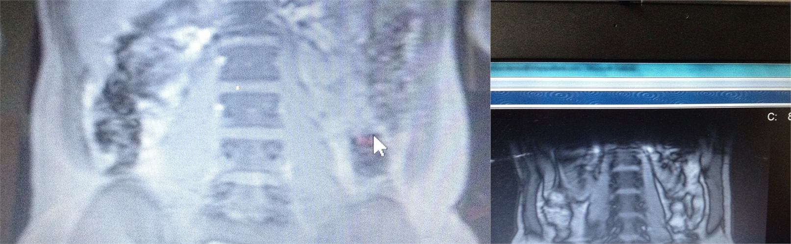 Before Liposuction Surgery Seattle and Tacoma, WA