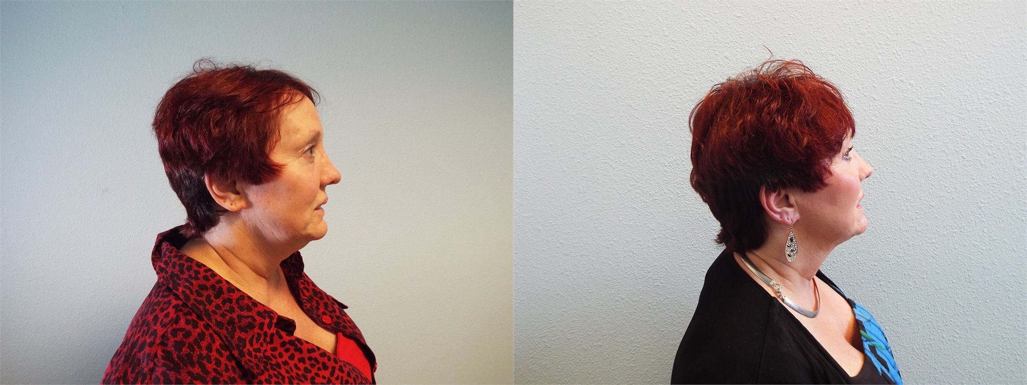 Neck Liposuction Before Surgery Tacoma, WA