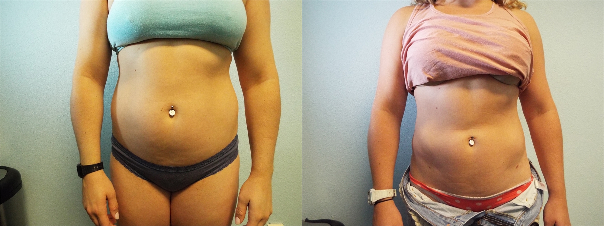 Liposuction Before Surgery Tacoma, WA