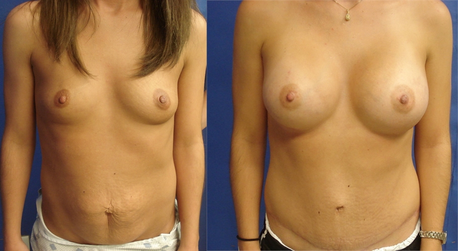 Before Mommy Makeover Surgery Tacoma, WA