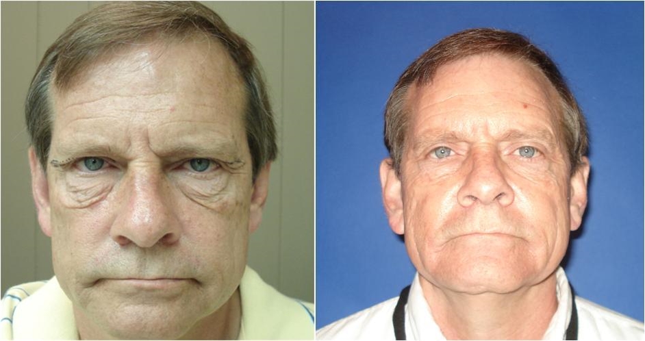 Blepharoplasty Before