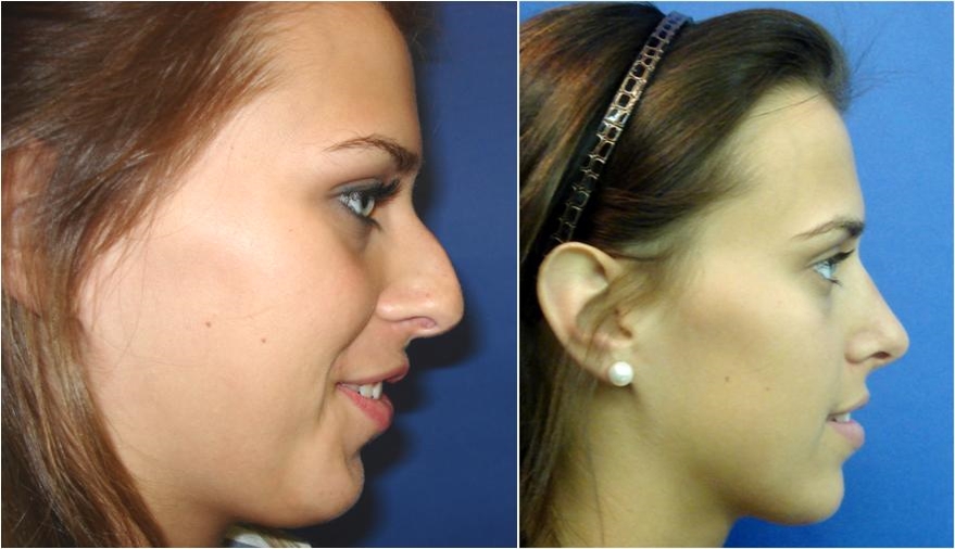 Rhinoplasty Before