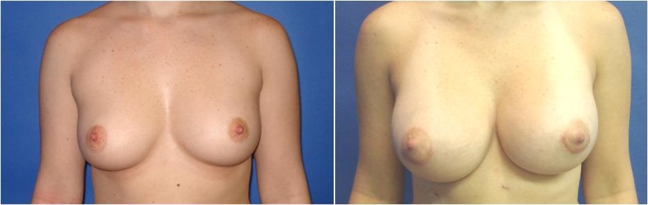 Before Saline Breast Augmentation Seattle and Tacoma, WA