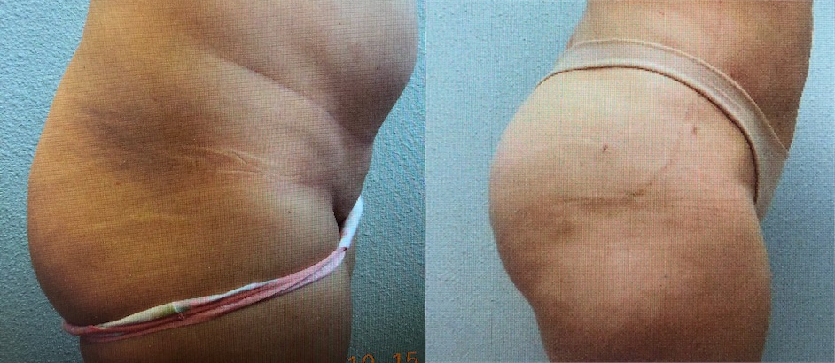 Body Contouring Before