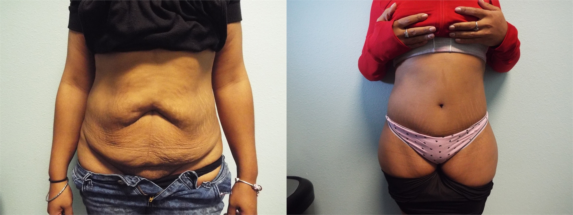 Tummy Tuck Before Surgery Seattle and Tacoma, WA