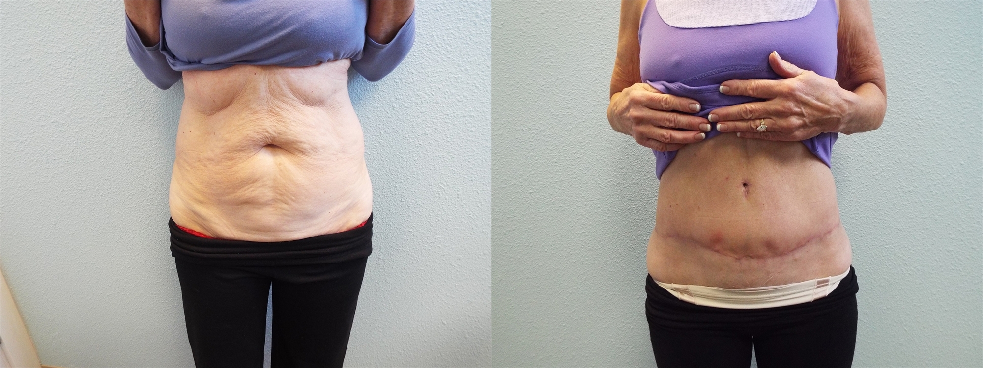 Before Tummy Tuck Surgery Tacoma, WA