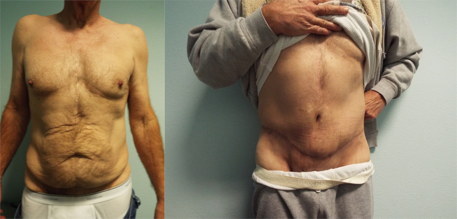 Tummy Tuck Before Surgery Tacoma, WA