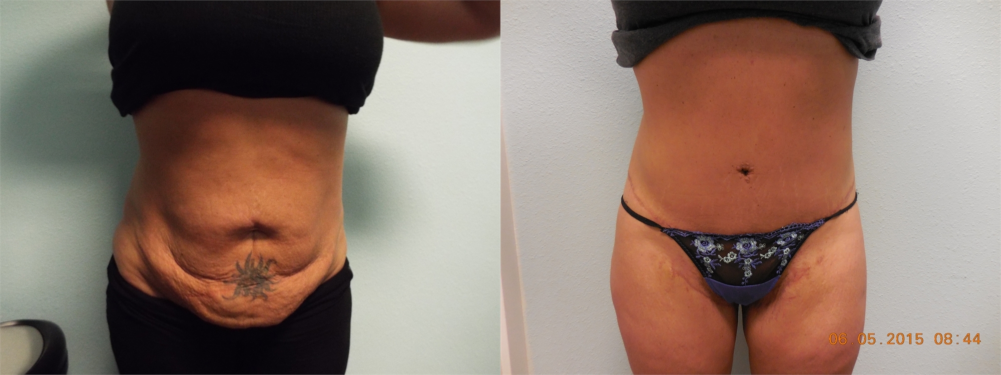 Tummy Tuck Before