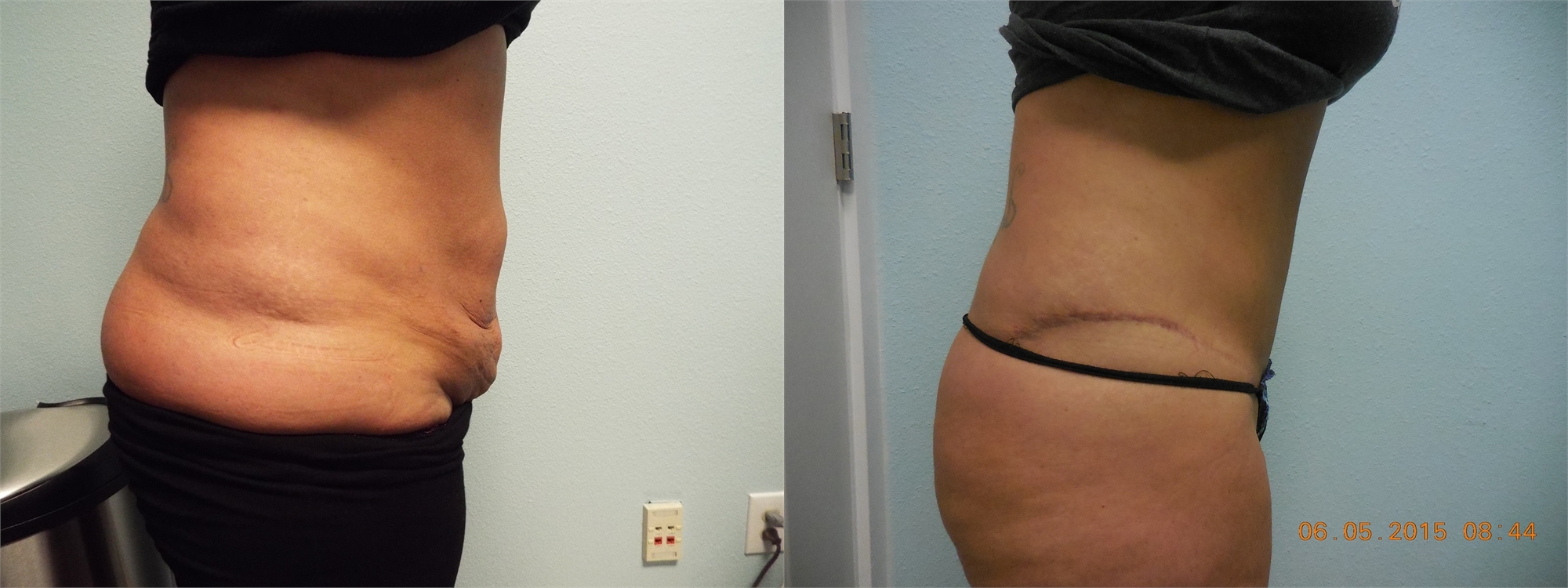Tummy Tuck Before