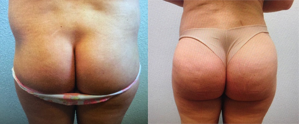 Body Contouring Before